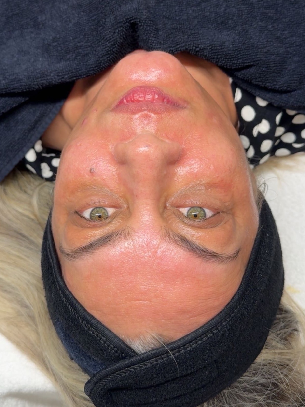 Na — GEZICHTSBEHANDELING — RF NEEDLING