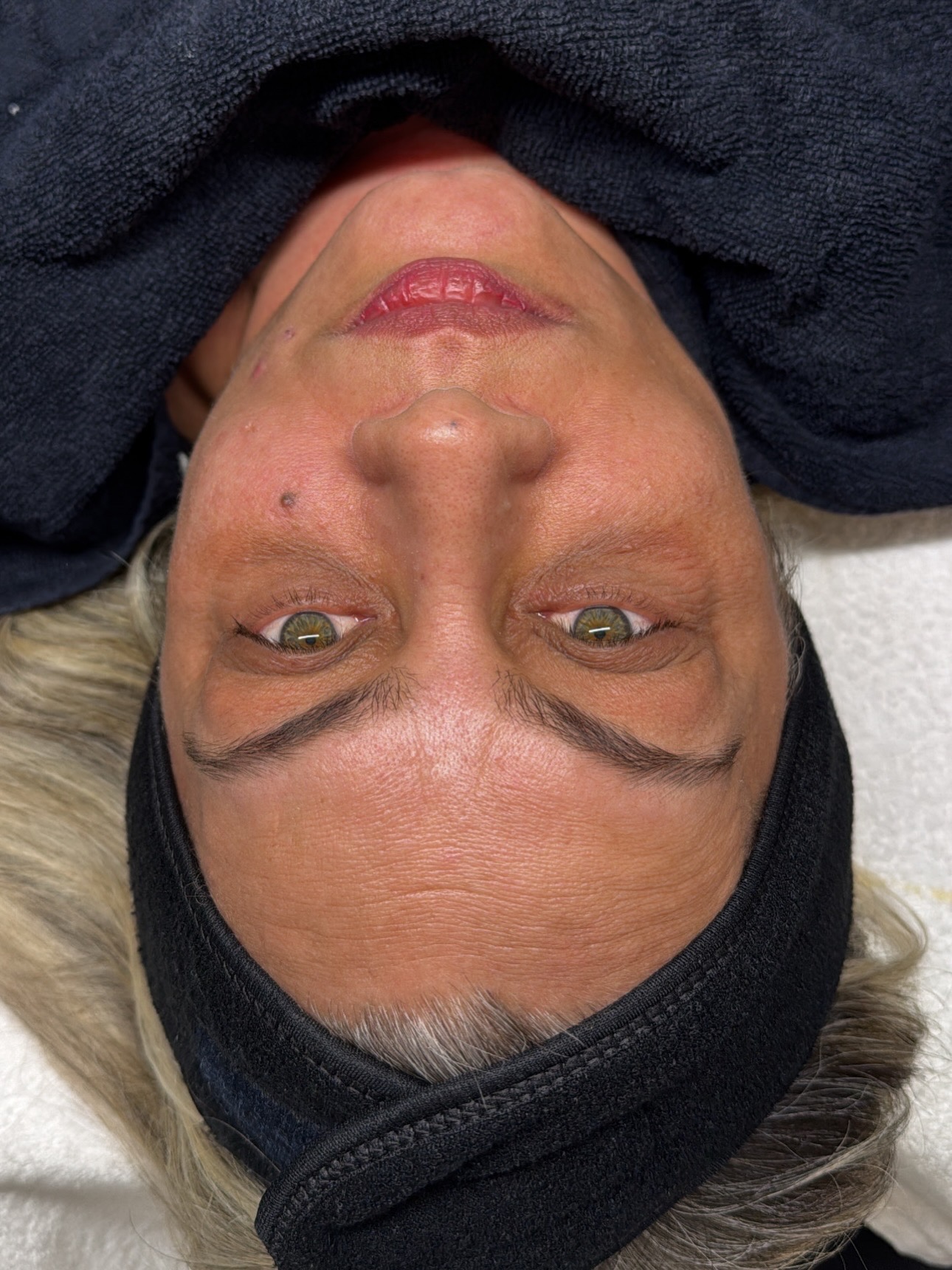 Voor — GEZICHTSBEHANDELING — RF NEEDLING
