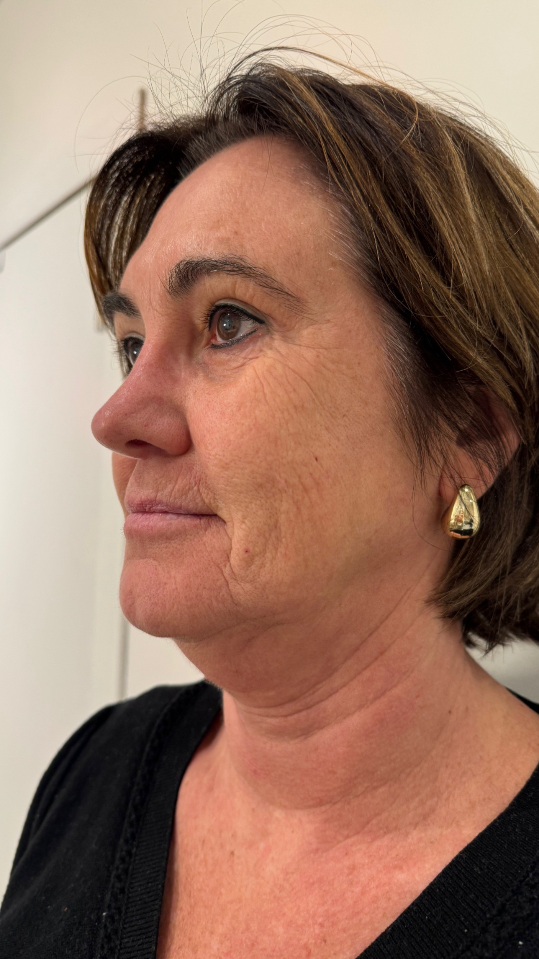 Voor — GEZICHTSBEHANDELING — HIFU